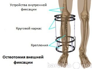 Продам: Аппарат Илизарова