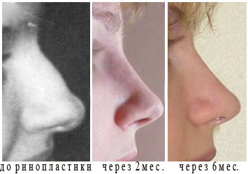Предложение: Пластическая хирургия носа, ринопластика