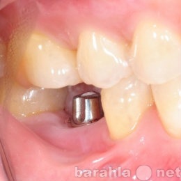 Предложение: Реставрация зуба.