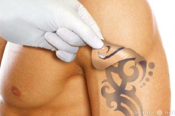 Предложение: Удаление татуировки
