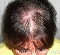 Предложение: Лечение выпадения волос, алопеция