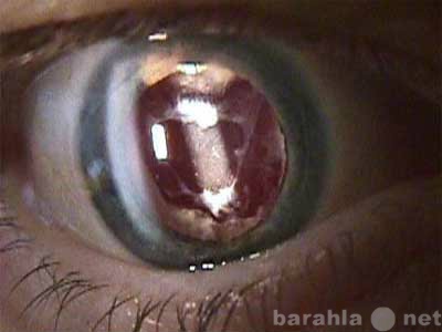 Предложение: Микрохирургия глаз и лечебные процедуры