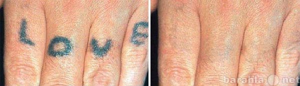 Предложение: Удаление татуировок, татуажа лазером