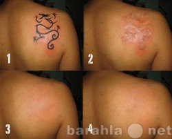 Предложение: Лазерное удаление татуировок и татуажа