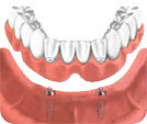 Предложение: Протезирование зубов на имплантатах