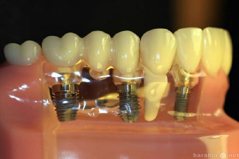Предложение: Протезирование зубов - новая технология