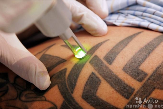 Предложение: Лазерное удаление тату