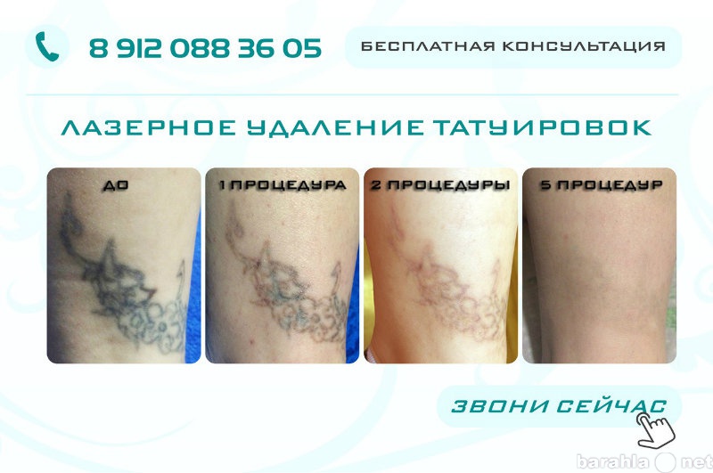 Предложение: Удаление татуировок